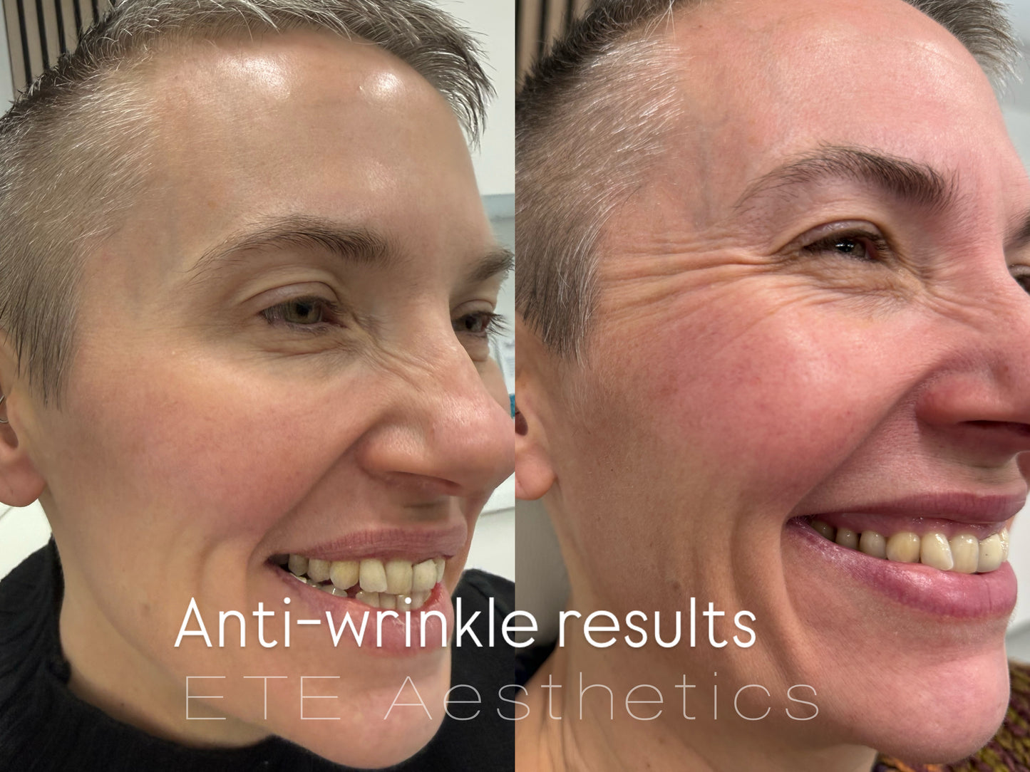 Anti-wrinkle injections 1 area