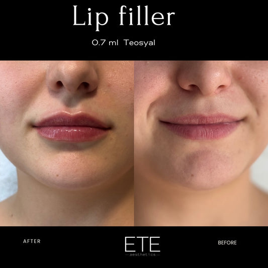 Lip augmentation 0.7 ml