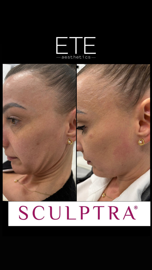 Sculptra 1 vial