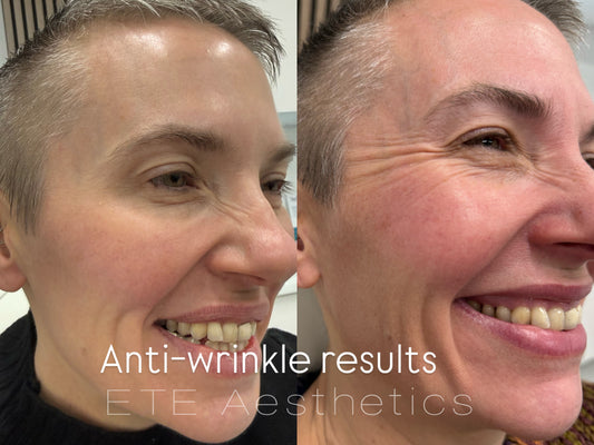 Anti-wrinkle injections 1 area