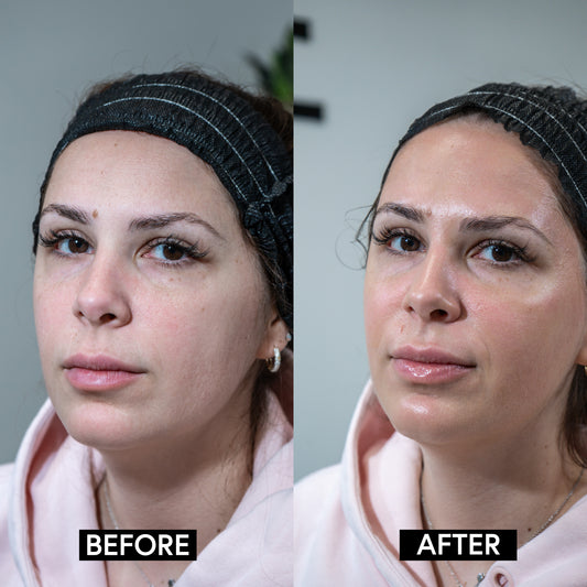 Obagi Blue Radiance Peels