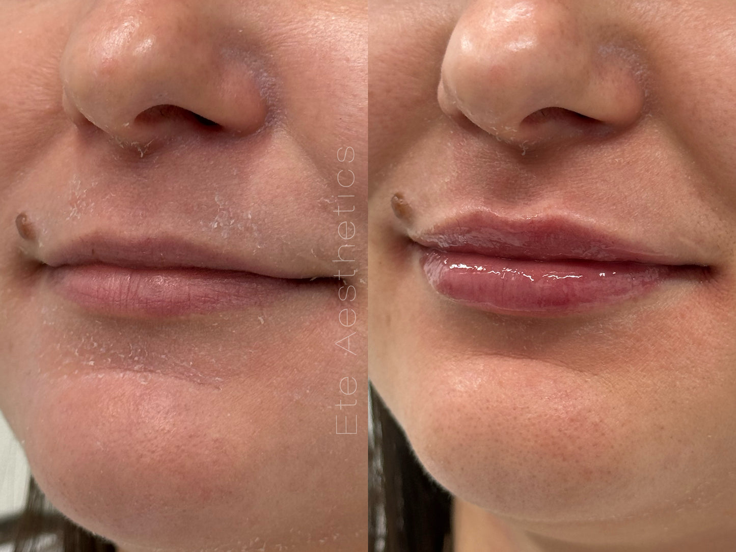 Lip augmentation 1 ml